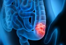 Faces of Blue: A Colorectal Cancer Survivor Story