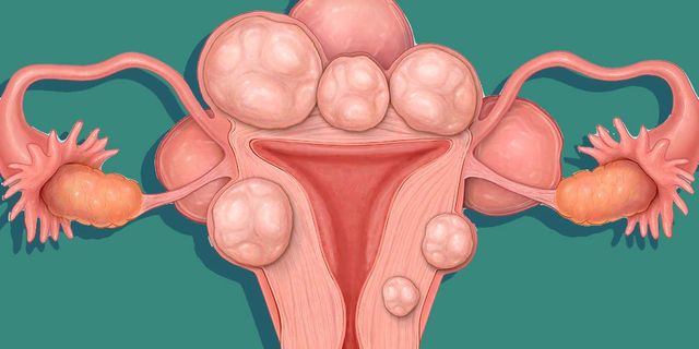 Let’s Talk About Uterine Fibroids